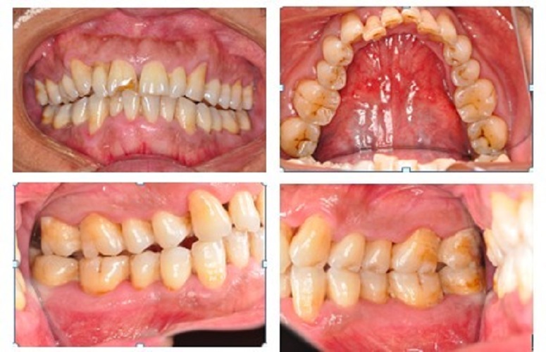 慢性牙周炎四部分图片