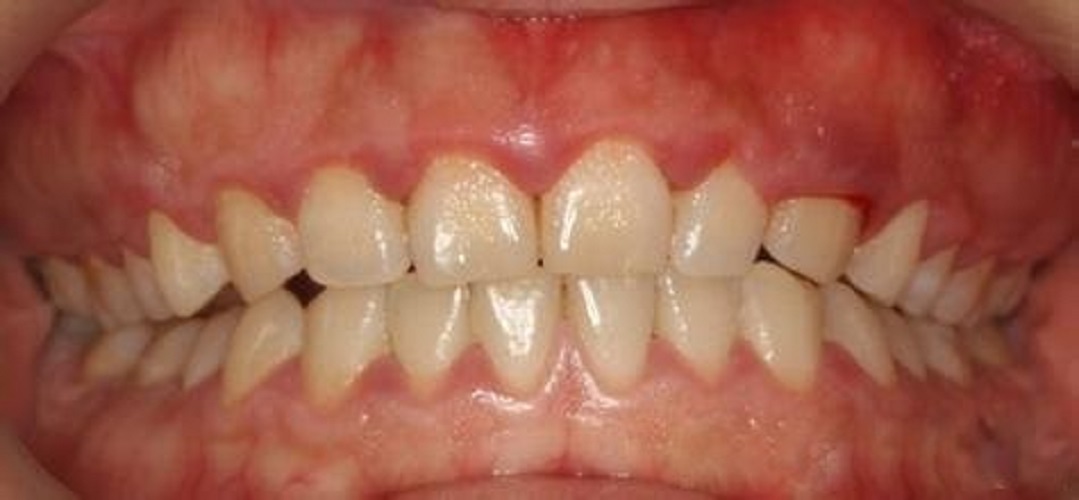 慢性牙周炎图片