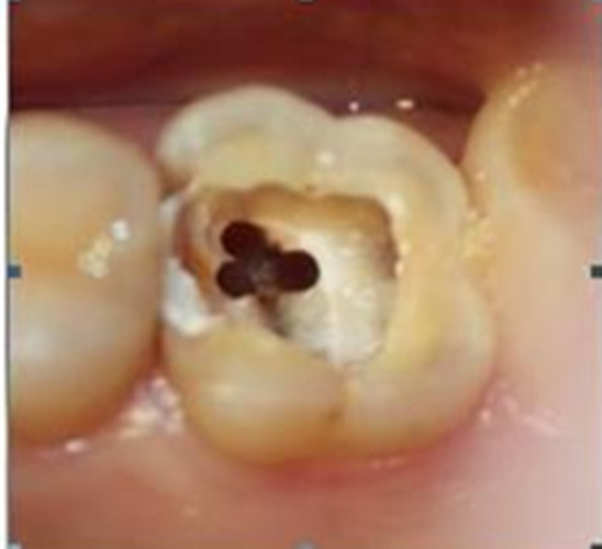 慢性牙髓炎的可复图片