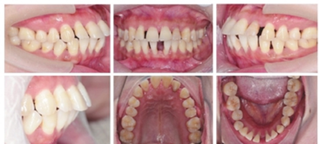 某患者的慢性牙周炎图片