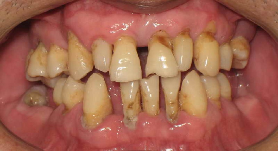 严重慢性牙周炎图片