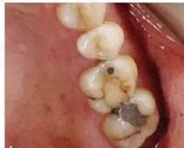 初期的慢性牙髓炎图片