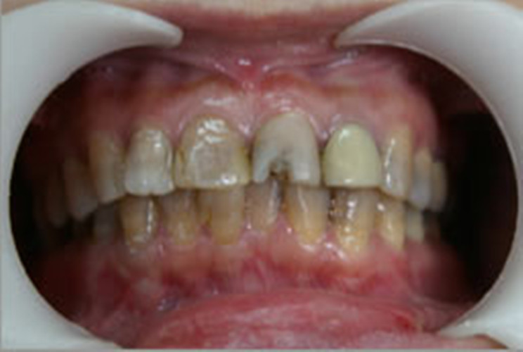 慢性的牙髓炎的图片