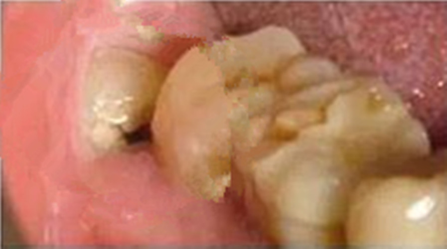 可复性慢性牙髓炎图片