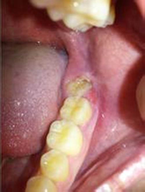 慢性牙髓炎口腔清晰图片