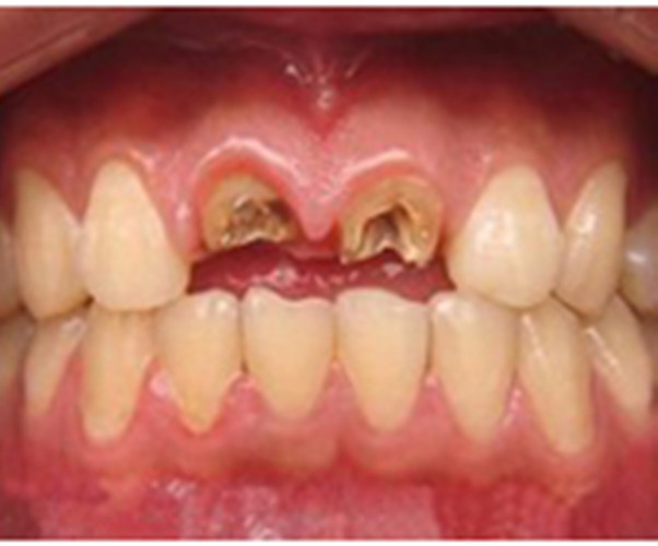慢性牙髓炎的重图片
