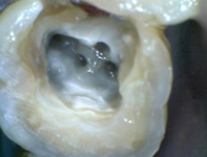 慢性牙髓炎可复的图片