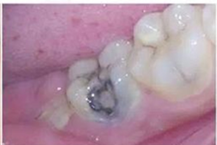 慢性牙髓炎平面口腔图片