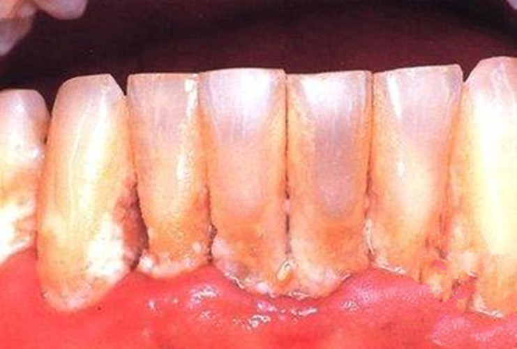 慢性牙髓炎轻型图片