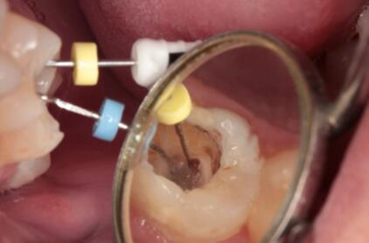 慢性牙髓炎手术图片 