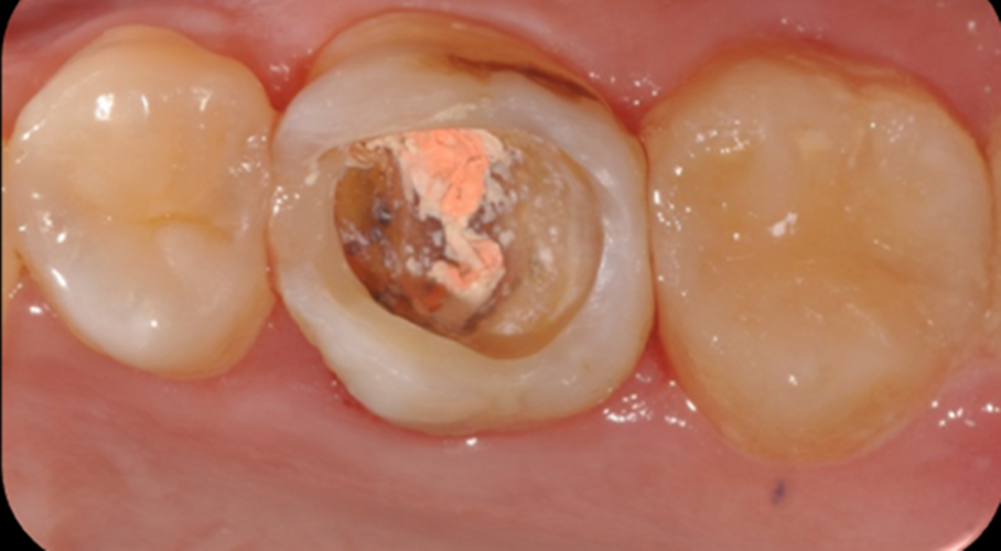 慢性牙髓炎治疗的图片