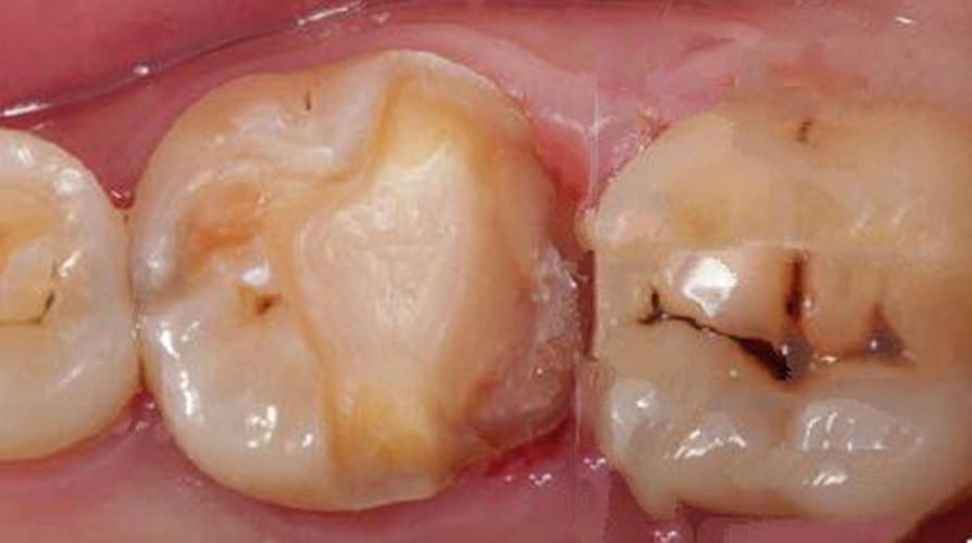 逆行性牙髓炎图片图片