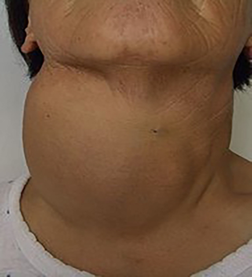 甲状腺瘤的早期症状图图片