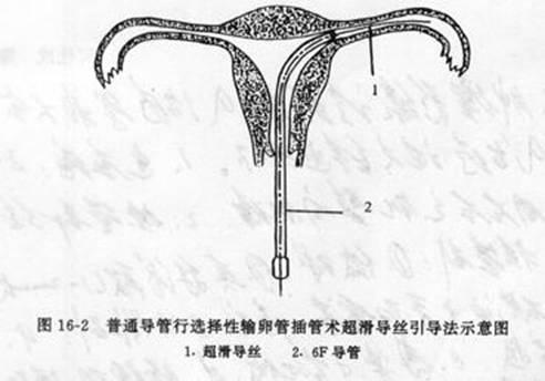 不孕不育的福音输卵管介入治疗