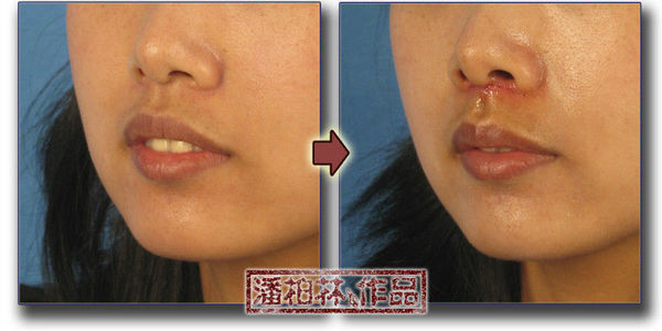 上唇人中延长术