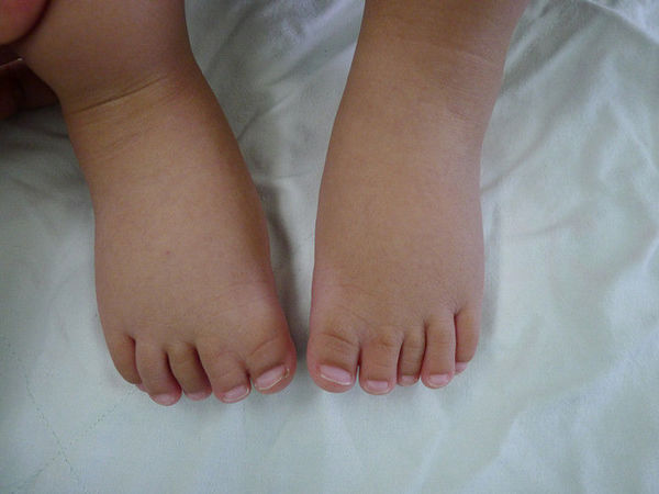 并趾手术不宜迟_先天性足畸形_症状_手术_症状表现_治疗方式 - 好大夫