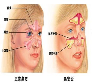 鼻竇炎的那些事?