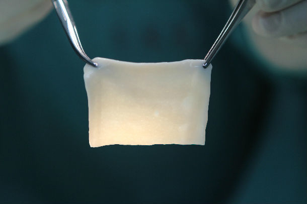 青少年(8岁以上)腹股沟疝生物补片修补手术