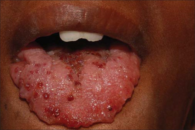 舌头毛细血管瘤的图片图片