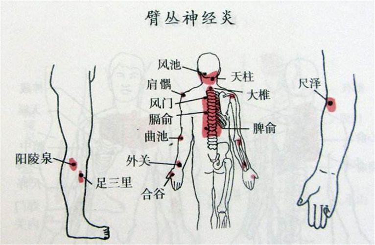 臂丛神经炎解说图片