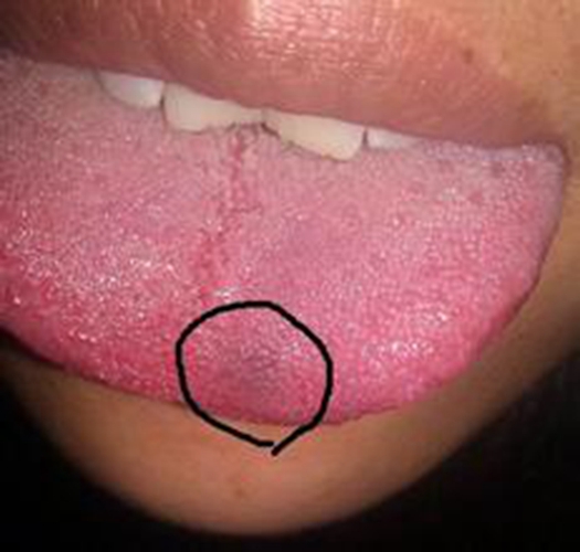 舌头上会长血管瘤图片图片