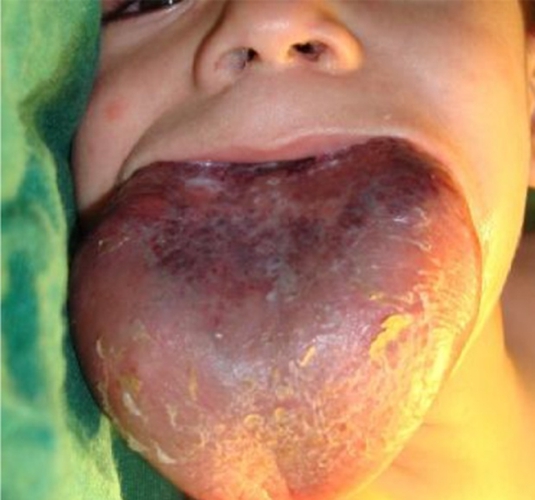 舌头上长了血管瘤图片图片