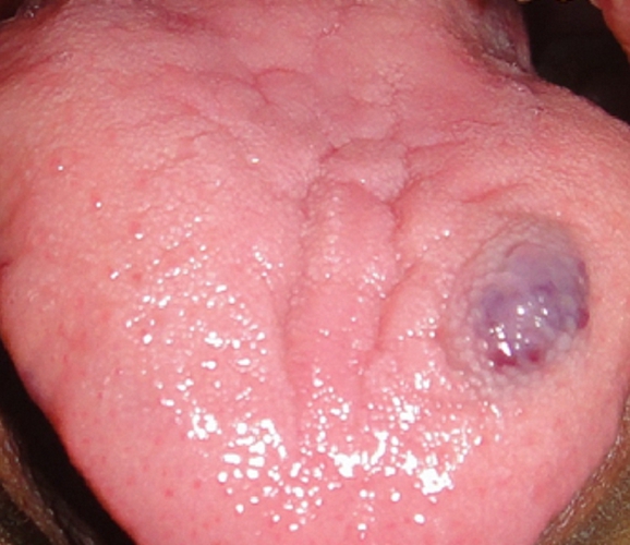 舌头边血管瘤图片大全图片