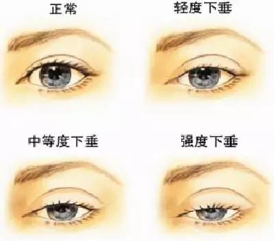 你真的是上睑下垂吗?