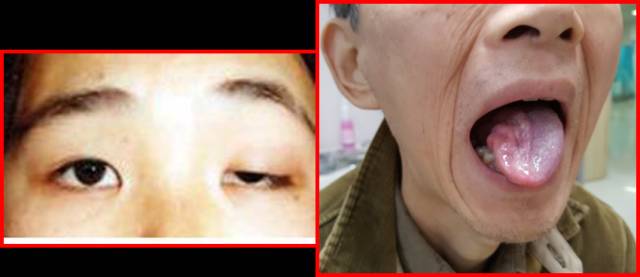 例如面麻,复视,眼球运动障碍,舌肌萎缩,伸舌偏斜(图5,视力下降,声音