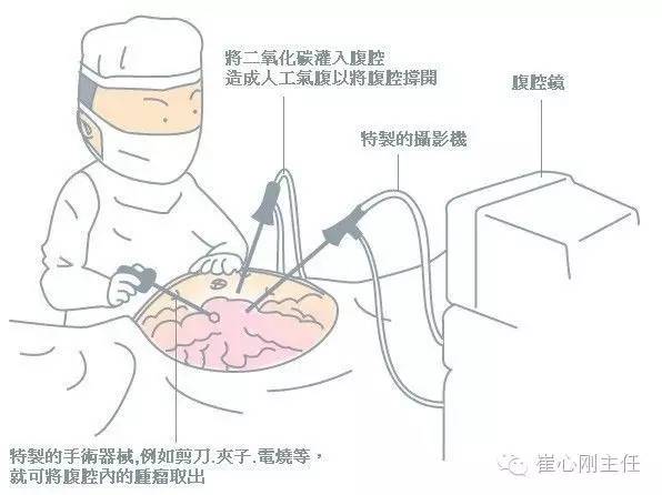 腹腔镜手术什么意思