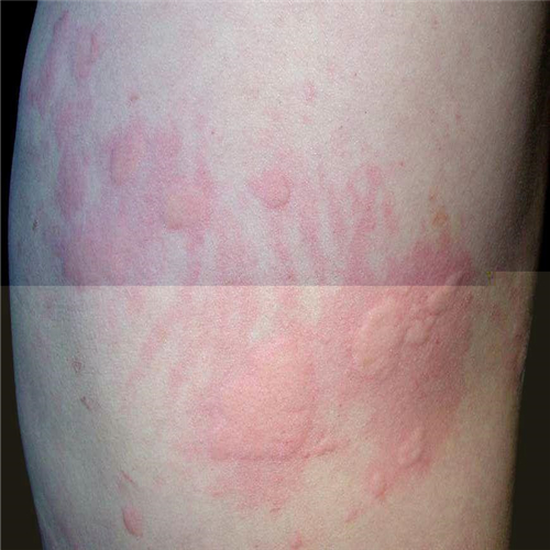 乙酰胆碱性荨麻疹图片图片