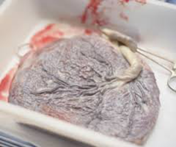 人胎盘具体形状特征图片