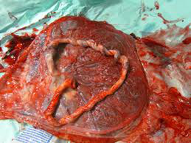 人胎盘的外形的特征图片