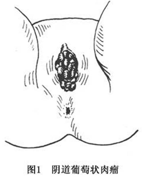 阴道口葡萄状肉瘤图片