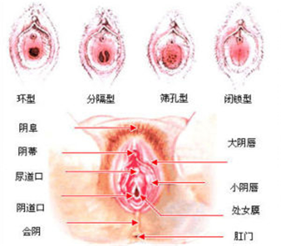 阴道口分型图片