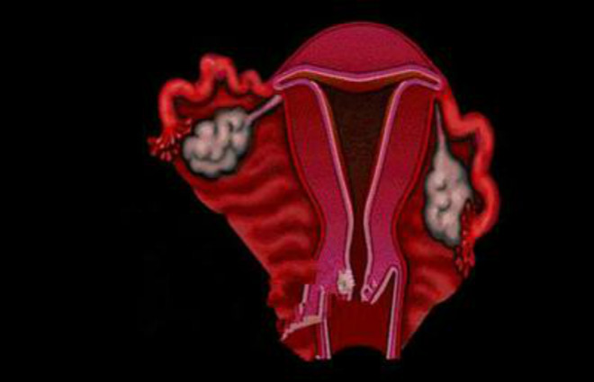 女性前庭大腺炎图片
