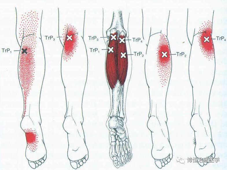 膕窩痛的重要因素——腓腸肌