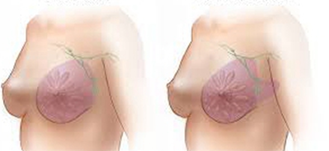 女性的乳腺癌早期的症状表现图片