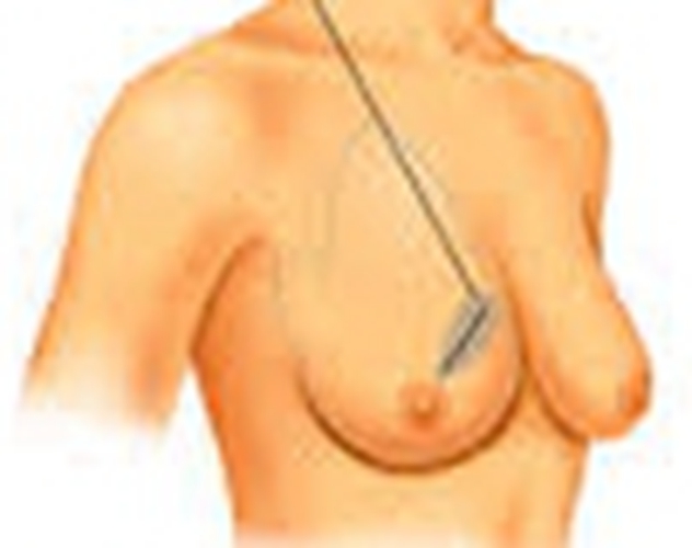 女性乳腺癌早期症状的表现的图片