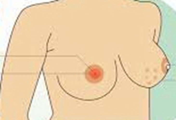 女性乳腺癌的早期症状的表现图片