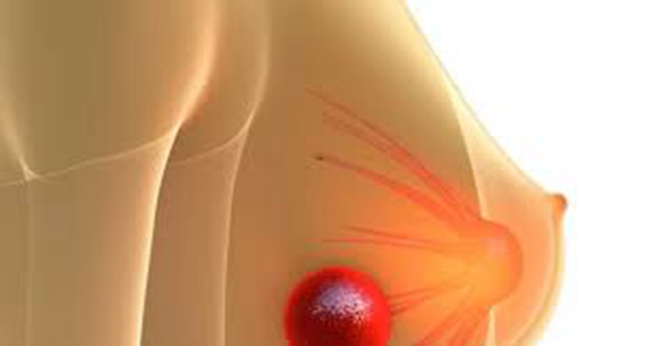 女性乳腺癌早期症状原理图片