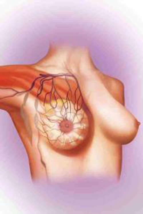 前期乳腺癌的征兆图片