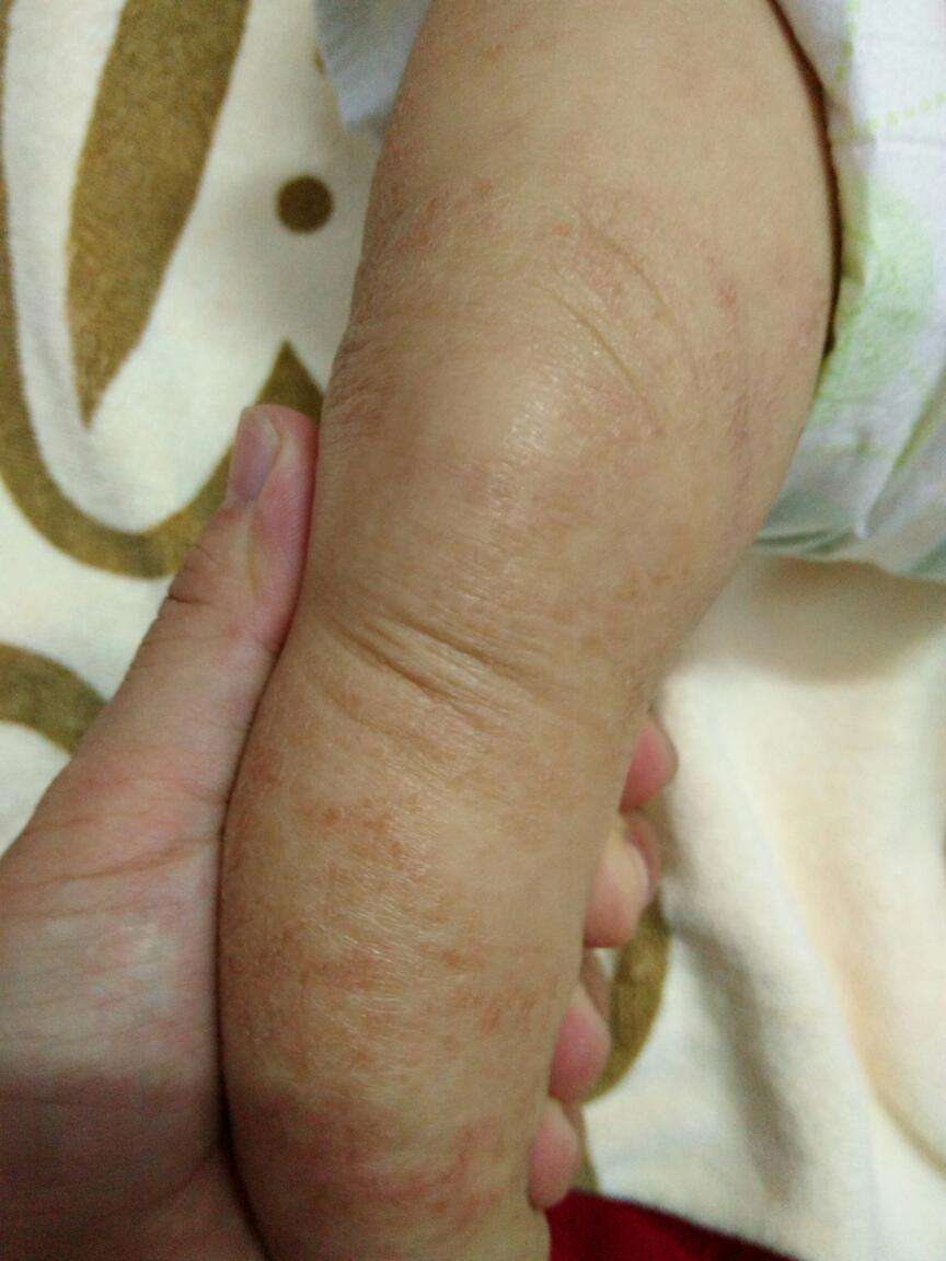 阴囊湿疹初期症状图片