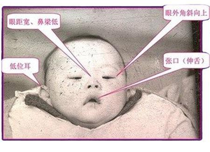新生儿呆小症最初症状图片