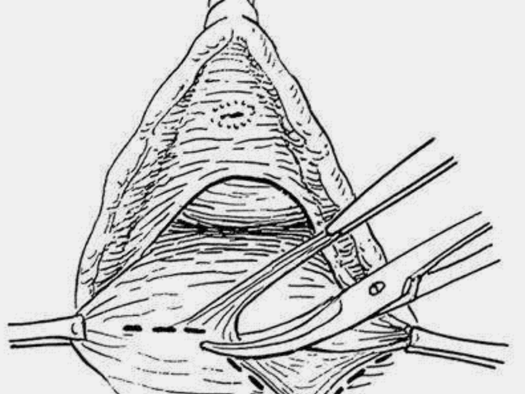 外科缝合针,缝合针,缝合针的型号规格介绍_大山谷图库