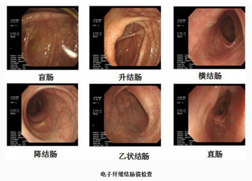 直肠癌的早期治疗方案图片