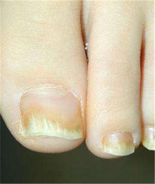 灰指甲初期图片脚趾头