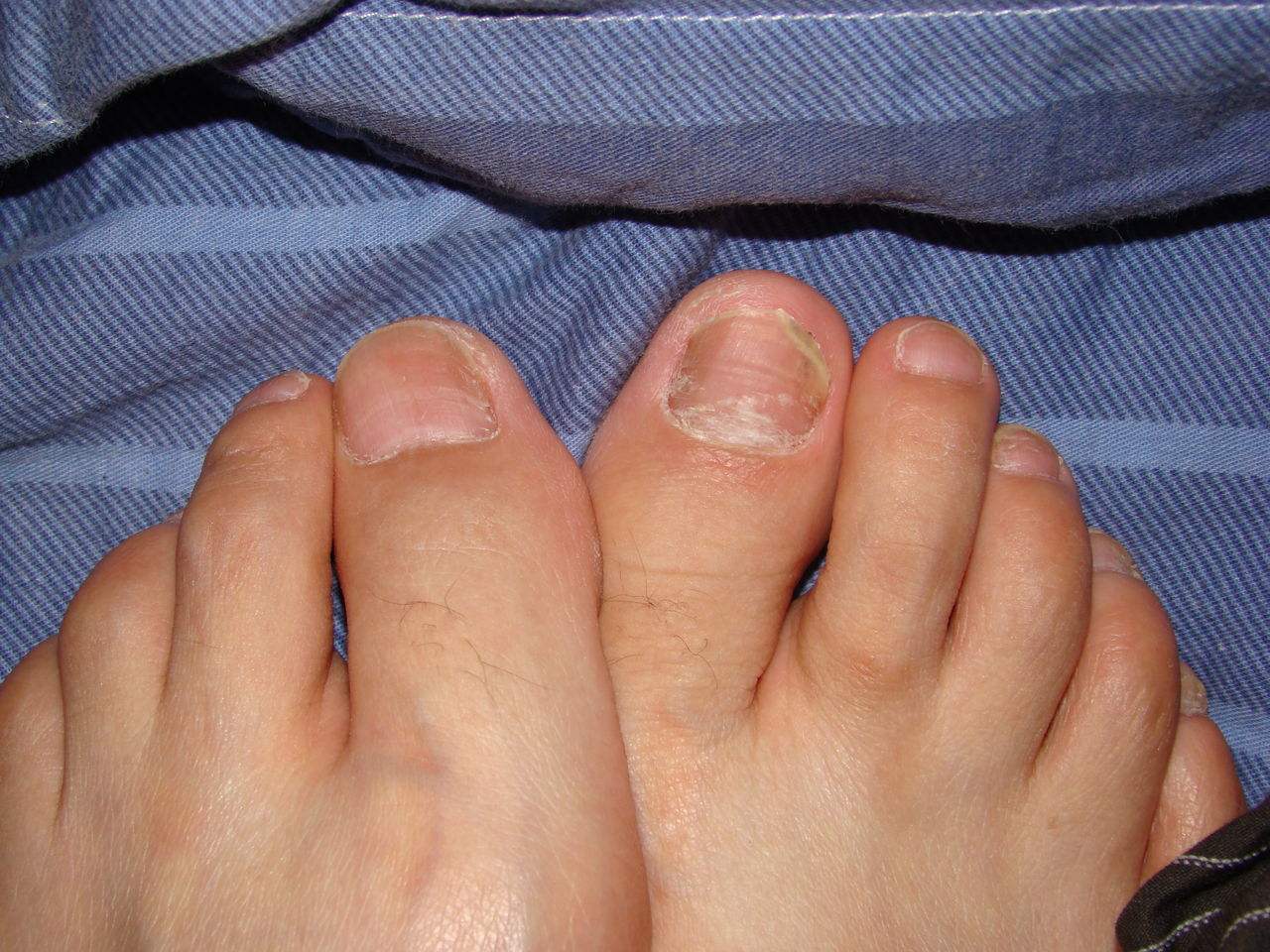 慢性灰指甲 初期图片