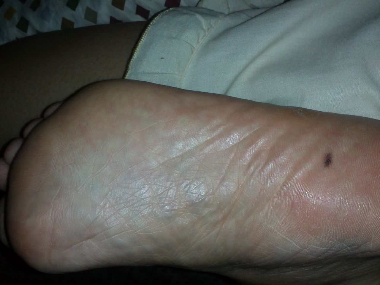 脚底黑色素瘤早期症状