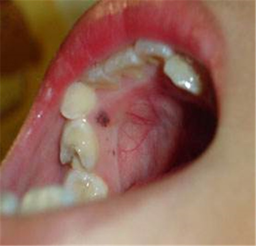 口腔瘤子图片 早期图片